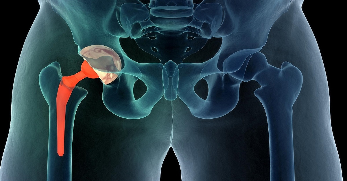 SamSMU has performed the first operation to replace the hip joint with an artificial joint