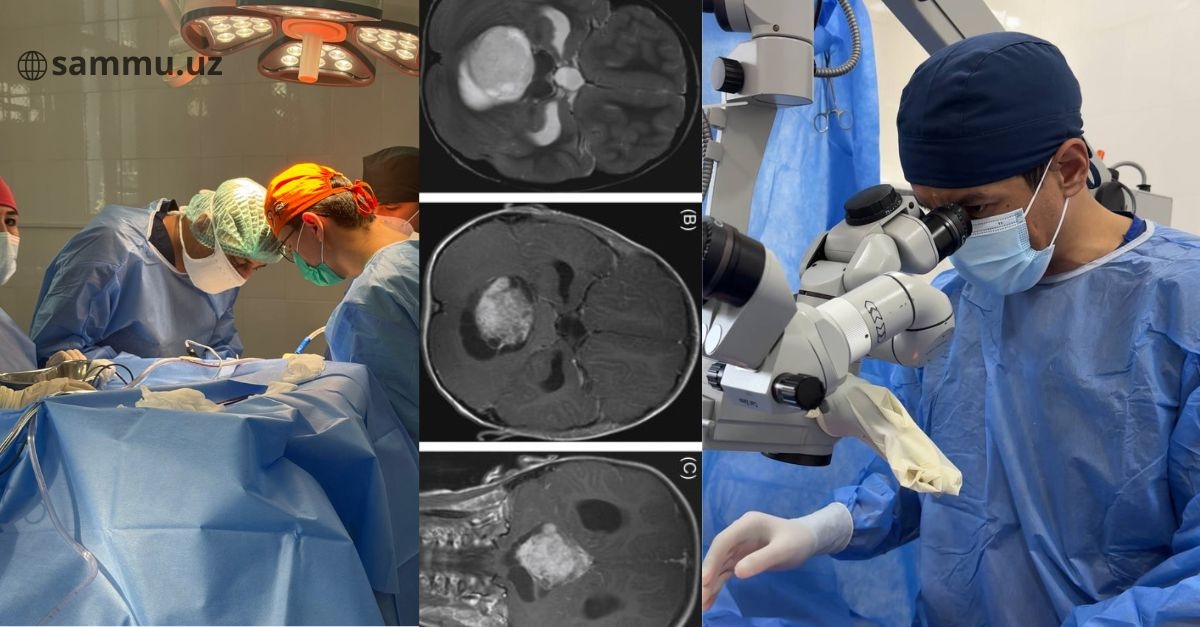 ​SamDTU huzuridagi Neyroxirurgiya va neyroreabilitatsiya ixtisoslashtirilgan ilmiy-amaliy markazida murakkab operatsiya amalga oshirildi